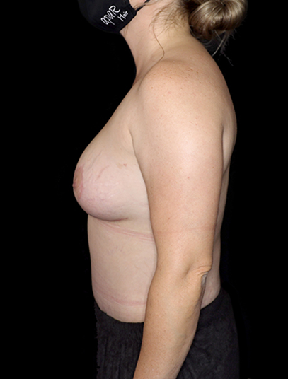 Breast fat grafting surgery - 16