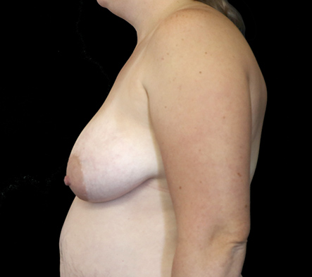 Postpartum abdominoplasty with abdominal wall reconstruction - 14