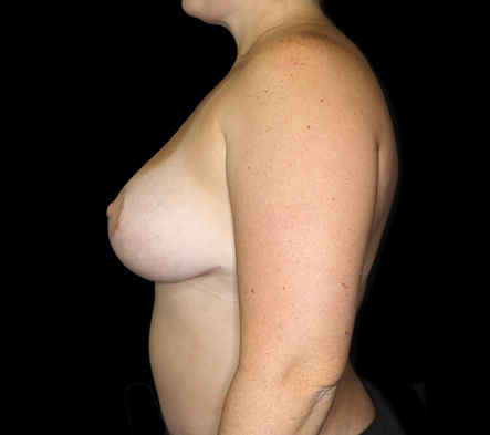 Postpartum abdominoplasty with abdominal wall reconstruction - 17