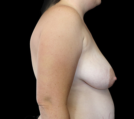 Postpartum abdominoplasty with abdominal wall reconstruction - 15