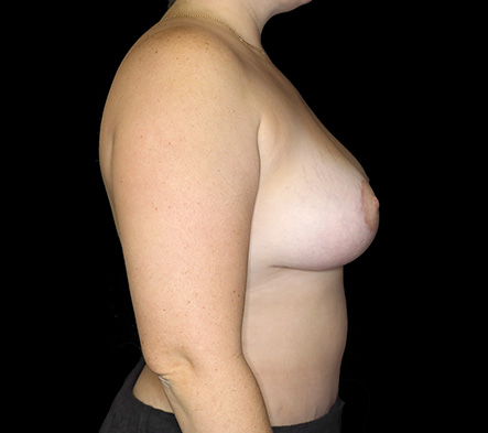 Postpartum abdominoplasty with abdominal wall reconstruction - 18