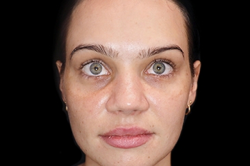 Facial and Revolumising Fillers - 1