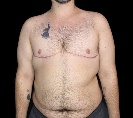 Subcutaneous bilateral mastectomy - 8