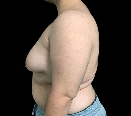 Subcutaneous bilateral mastectomy - 6