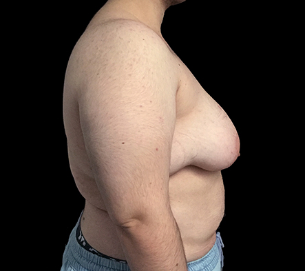 Subcutaneous bilateral mastectomy - 7