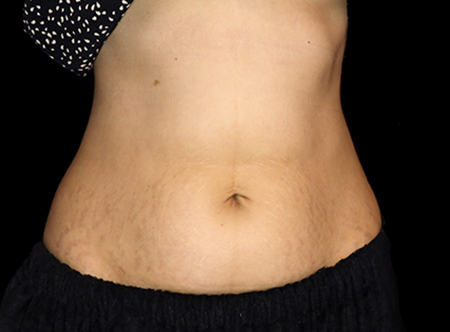 Postpartum abdominoplasty with abdominal wall reconstruction - 70