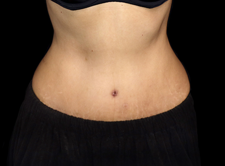 Postpartum abdominoplasty with abdominal wall reconstruction - 73