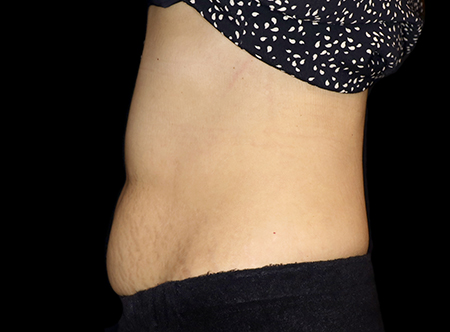 Postpartum abdominoplasty with abdominal wall reconstruction - 71