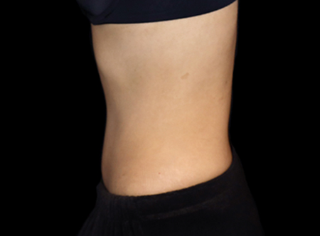Postpartum abdominoplasty with abdominal wall reconstruction - 74