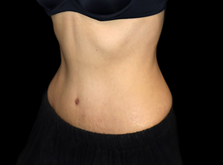 Postpartum abdominoplasty with abdominal wall reconstruction - 75