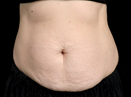 Postpartum abdominoplasty with abdominal wall reconstruction - 76