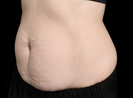 Postpartum abdominoplasty with abdominal wall reconstruction - 77