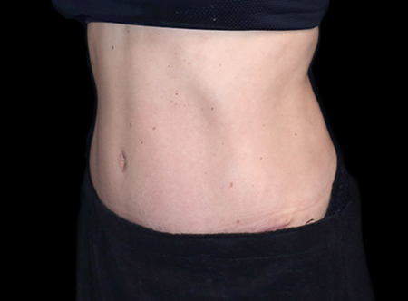 Postpartum abdominoplasty with abdominal wall reconstruction - 80