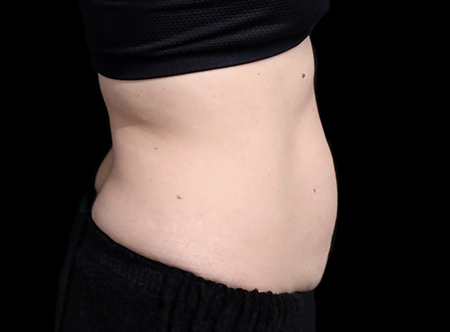 Postpartum abdominoplasty with abdominal wall reconstruction - 78