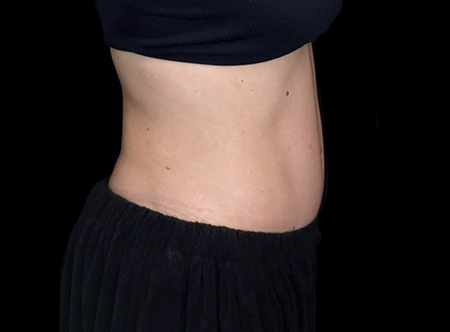 Postpartum abdominoplasty with abdominal wall reconstruction - 81