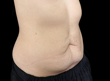 Postpartum abdominoplasty with abdominal wall reconstruction - 65