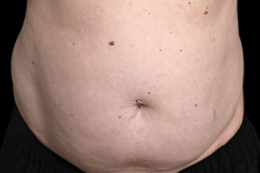 Postpartum abdominoplasty with abdominal wall reconstruction - 56