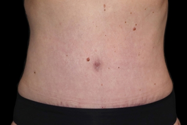 Postpartum abdominoplasty with abdominal wall reconstruction - 57