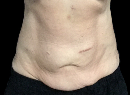Postpartum abdominoplasty with abdominal wall reconstruction - 58