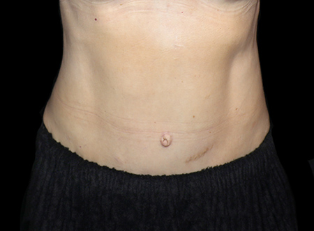 Postpartum abdominoplasty with abdominal wall reconstruction - 61