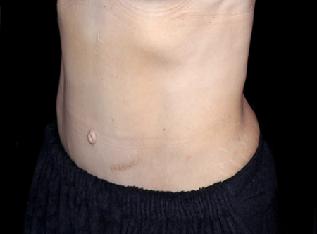 Postpartum abdominoplasty with abdominal wall reconstruction - 62