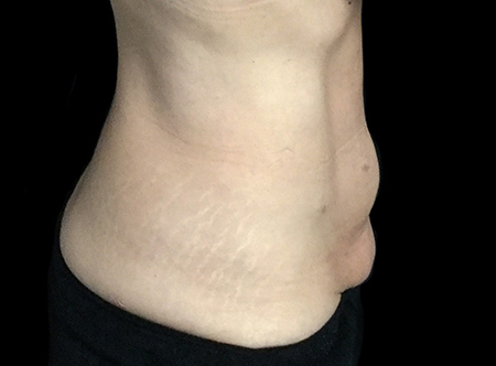 Postpartum abdominoplasty with abdominal wall reconstruction - 60