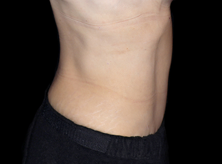 Postpartum abdominoplasty with abdominal wall reconstruction - 63