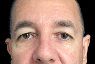 Blepharoplasty – Eyelid lift - 1