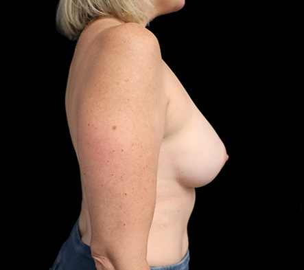 Breast fat grafting surgery - 7