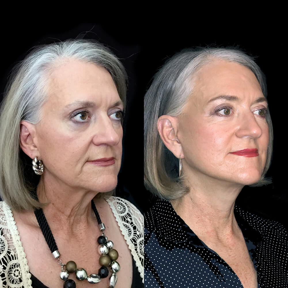 Facelift vs Thread Lift | What's the difference? - 2