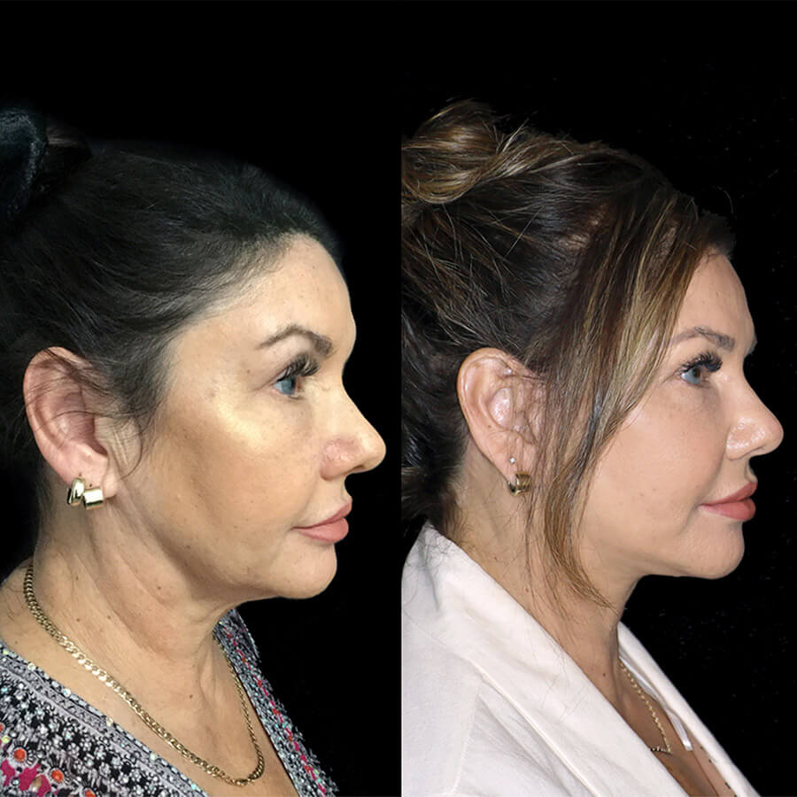 Facelift vs Thread Lift | What's the difference? - 1