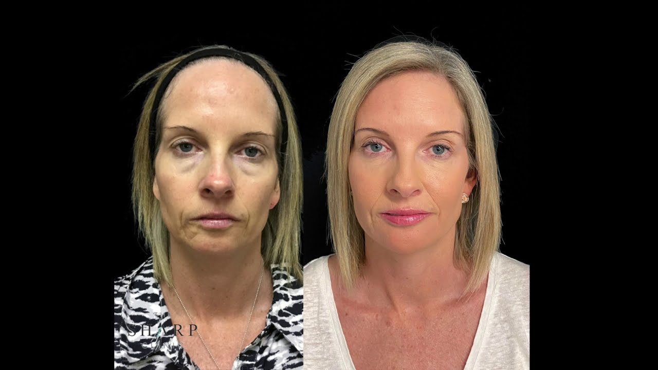 Before and after injectables